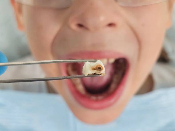 Best Emergency Dental Care for Abscessed Tooth in Smithfield, VA